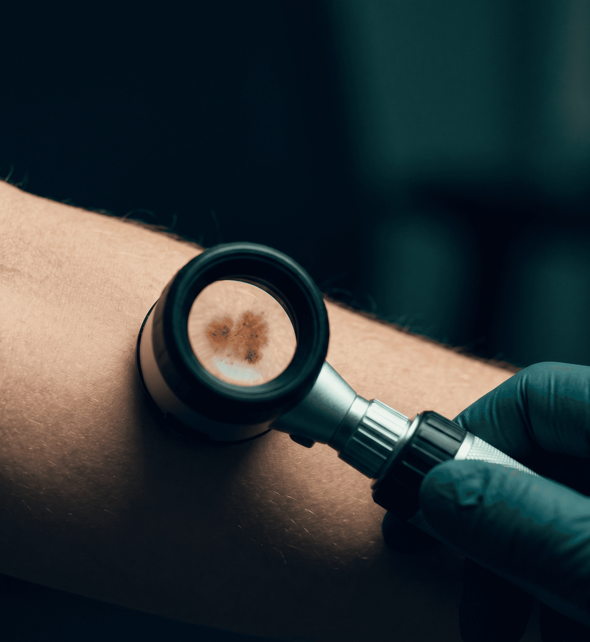 Polarized handheld dermatoscope examining a pigmented lesion on skin